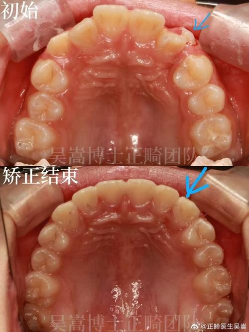 虎牙不拔牙矫正牙齿-图3