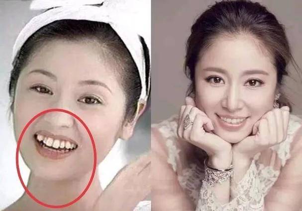 明星不拔牙矫正牙齿真的可行吗？-图3
