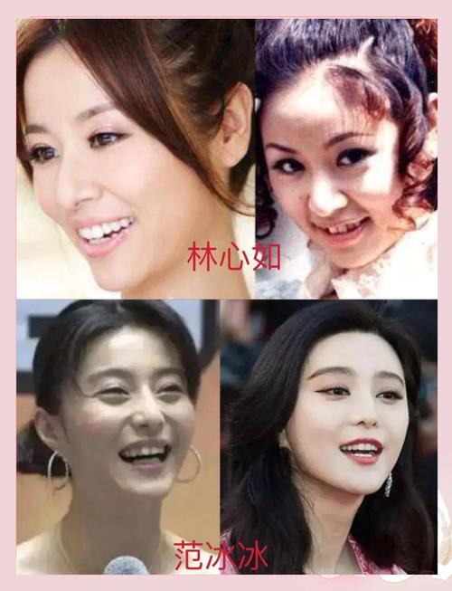 明星不拔牙矫正牙齿真的可行吗？-图2