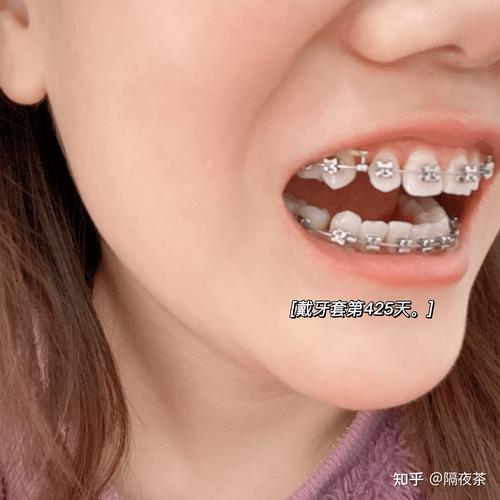 26岁矫正牙齿晚不晚？成年人矫正还来得及吗？-图2