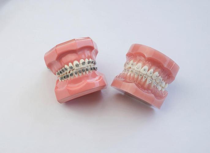 26岁矫正牙齿晚不晚？成年人矫正还来得及吗？-图3