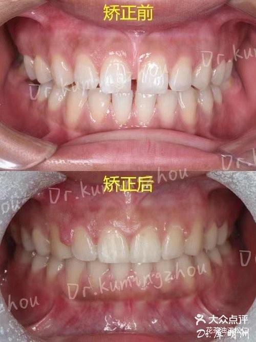 杭州矫正牙齿哪里好？专业机构怎么选？-图3