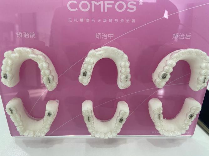 格莱美牙齿隐形矫正效果如何？舒适度和安全性怎么样？-图1