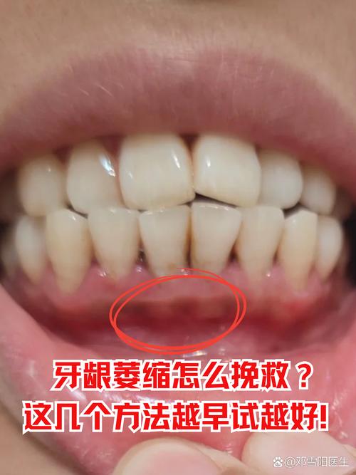 牙齿矫正后牙龈萎缩，矫正过程是诱因吗？-图3