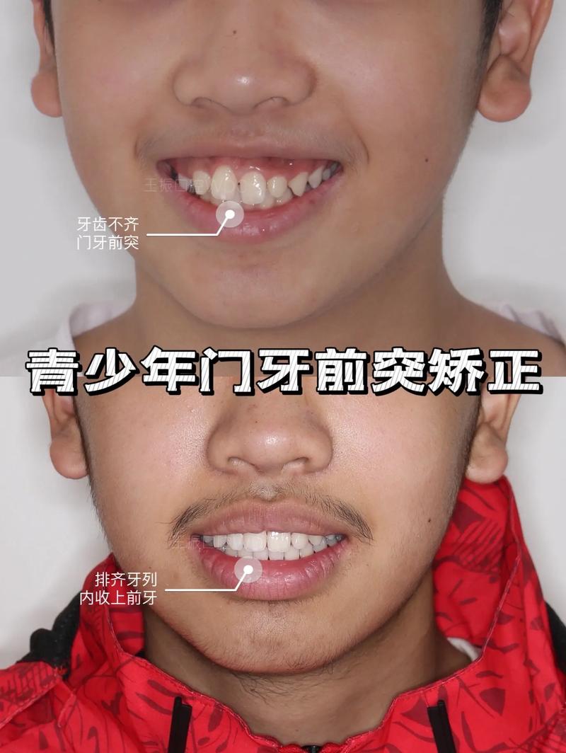 上海青少年矫正牙齿，最佳矫正年龄是几岁？-图3