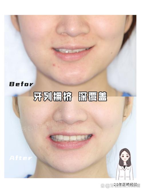 矫正牙齿磨牙有害吗？真相是？-图3