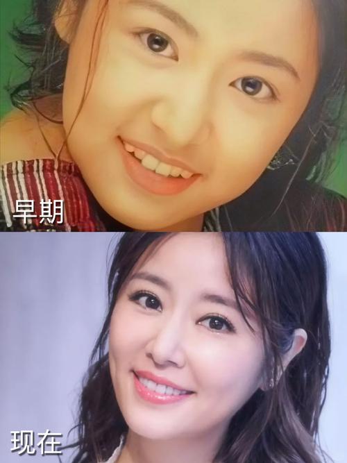 林心如矫正牙齿图片引猜测,为何突然矫正?效果引关注?-图1 林心如矫正牙齿图片引猜测,为何突然矫正?效果引关注?-图1
