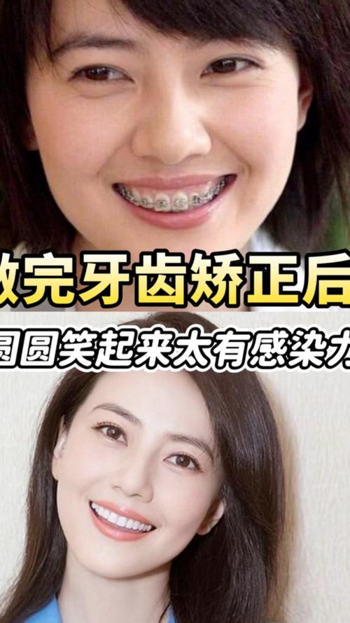 高圆圆牙齿矫正前后变化有多大？-图2