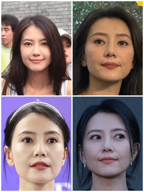 高圆圆牙齿矫正前后变化有多大？-图3