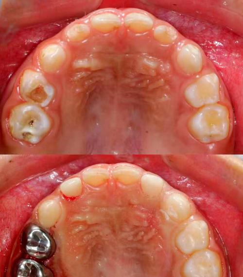 成人矫正牙齿后，美容冠有必要吗？效果如何？-图1