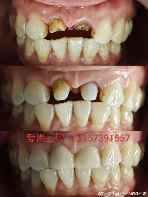 成人矫正牙齿后，美容冠有必要吗？效果如何？-图3