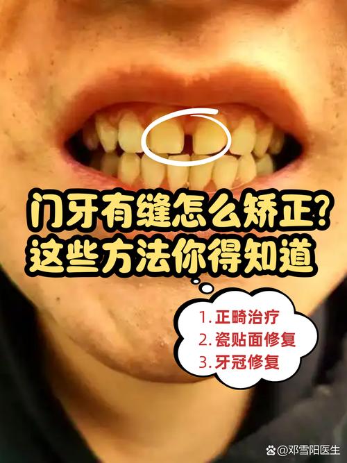 矫正后门牙仍有缝隙？原因和解决方法是什么？-图2