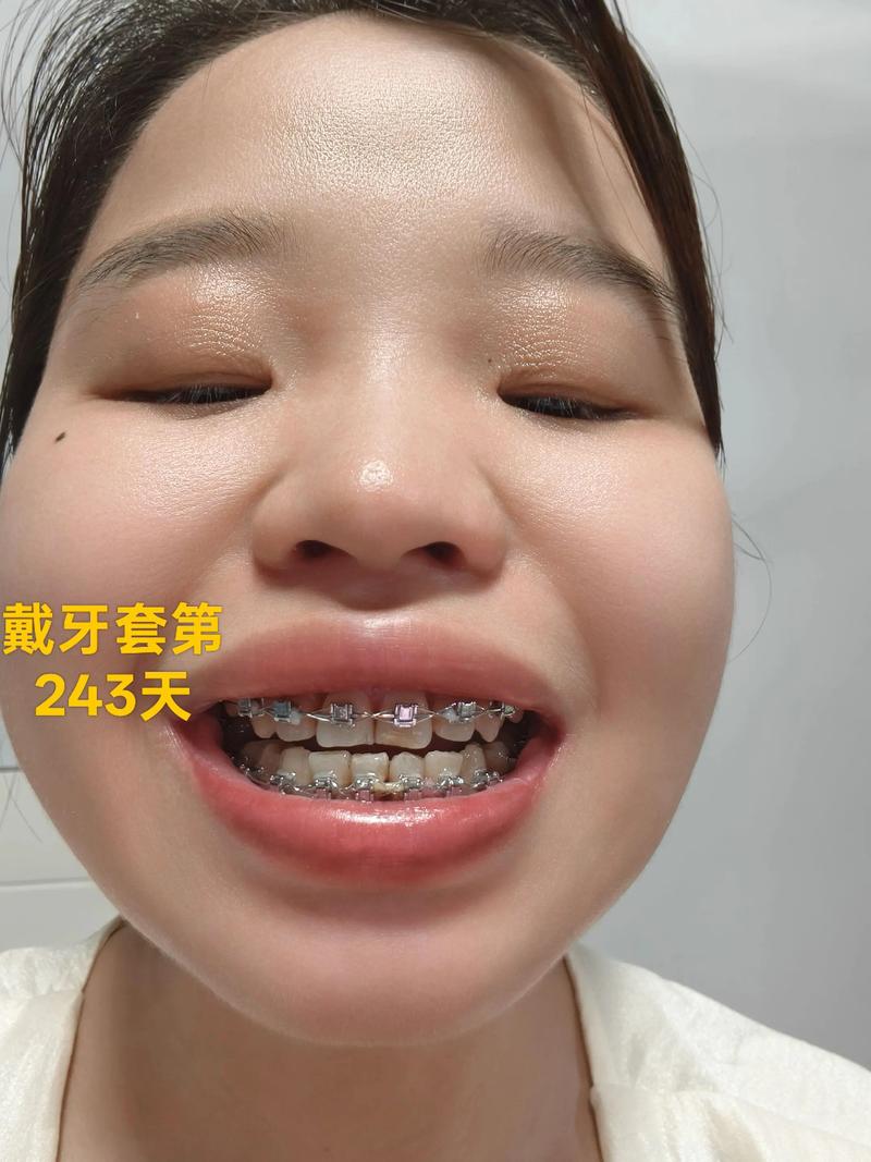 30岁矫正牙齿效果如何？真实案例分享有参考价值吗？-图1