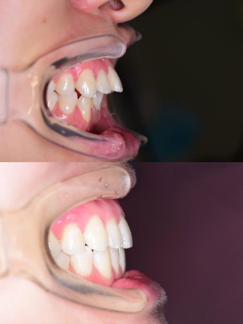 成人矫正牙齿效果真的能好吗？-图1