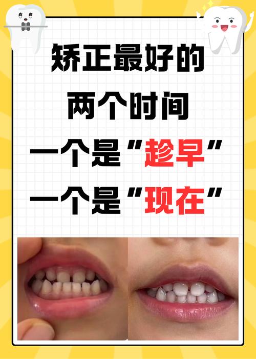 牙齿矫正黄金年龄是几岁?早矫正和晚矫正效果差多少?-图1 牙齿矫正黄金年龄是几岁?早矫正和晚矫正效果差多少?-图1