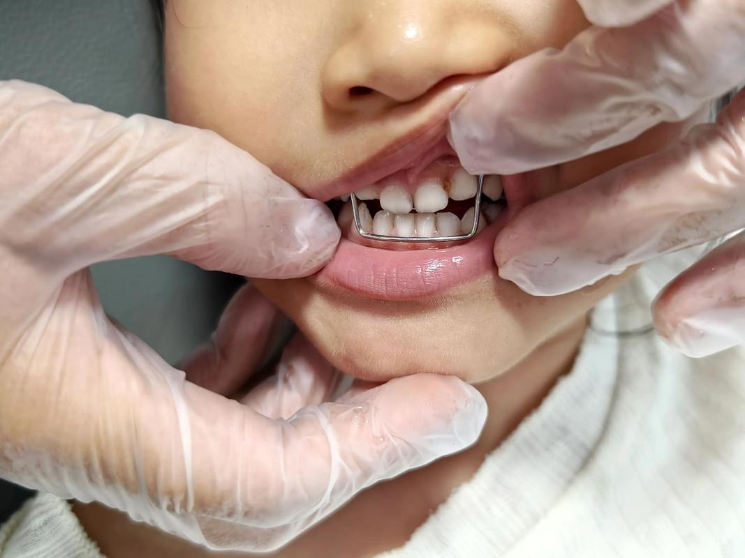 小孩地包天矫正什么时候开始最合适？-图1