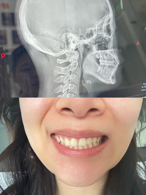 牙齿片切矫正效果图效果自然吗?会损伤牙齿吗?-图3 牙齿片切矫正效果图效果自然吗?会损伤牙齿吗?-图3