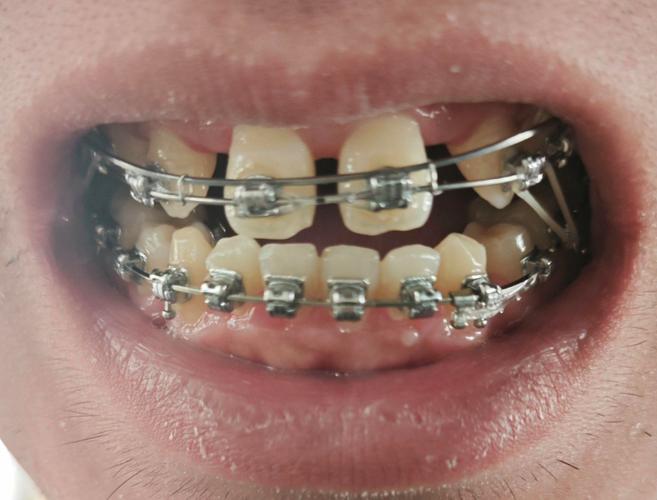 22岁矫正牙齿来得及吗？成年人矫正要注意啥？-图2