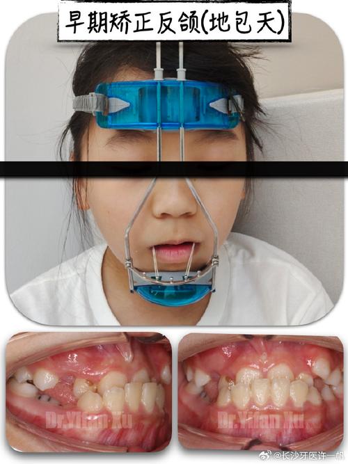 扩弓矫正牙齿矫正有哪些潜在危害？-图3