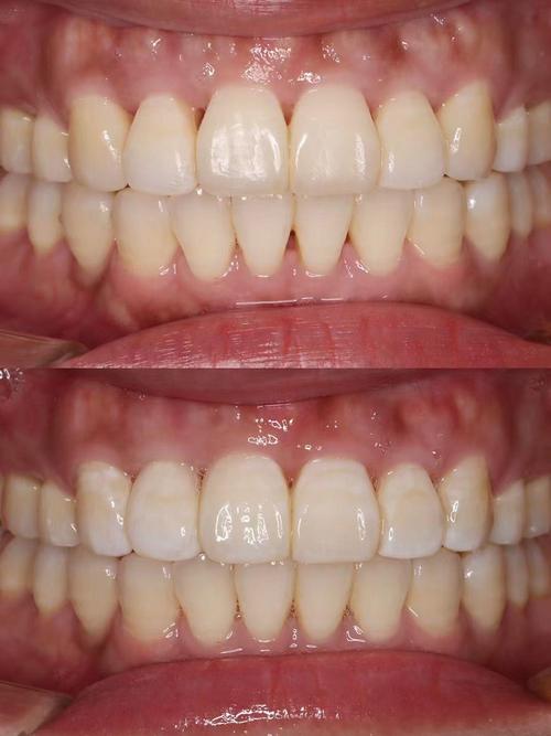 牙齿矫正黑三角图片-图2