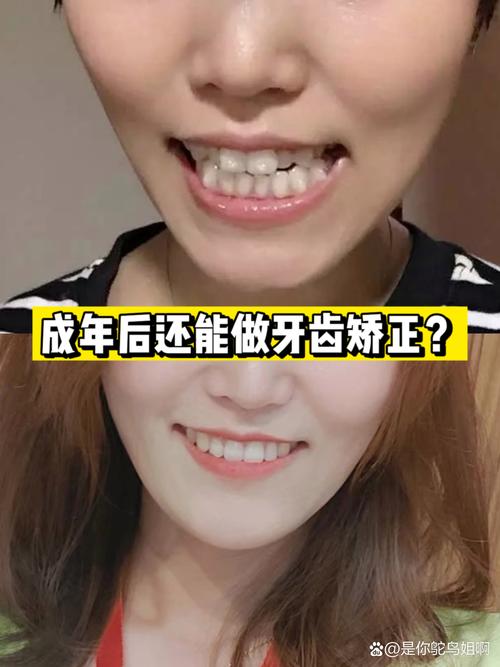 成人还能牙齿矫正吗-图2 成人还能牙齿矫正吗-图2