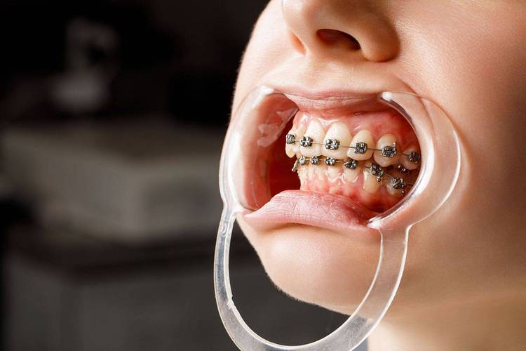 隐形矫正牙齿效果究竟如何？舒适度、适用人群及注意事项详解？-图1