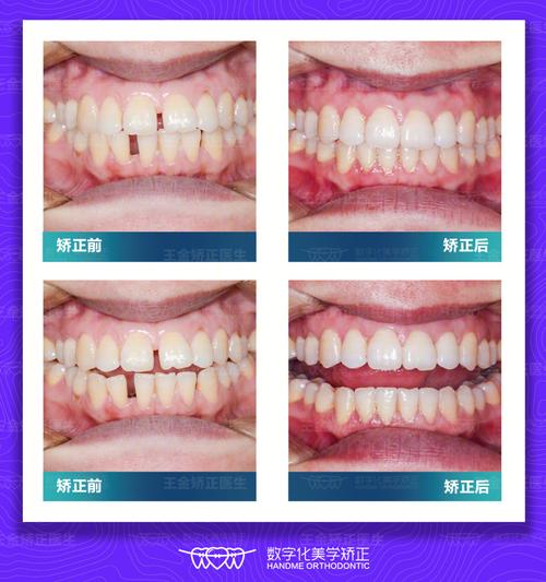 牙齿稀疏能矫正吗？矫正方法有哪些？-图1