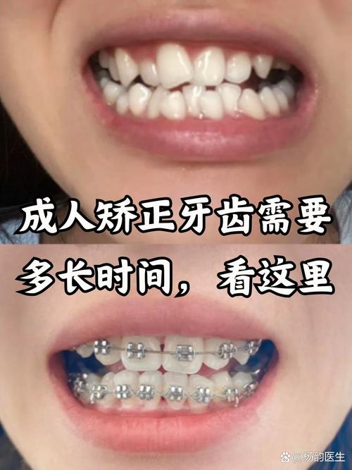 成年人矫正牙齿可行吗？效果和时机怎么选？-图1