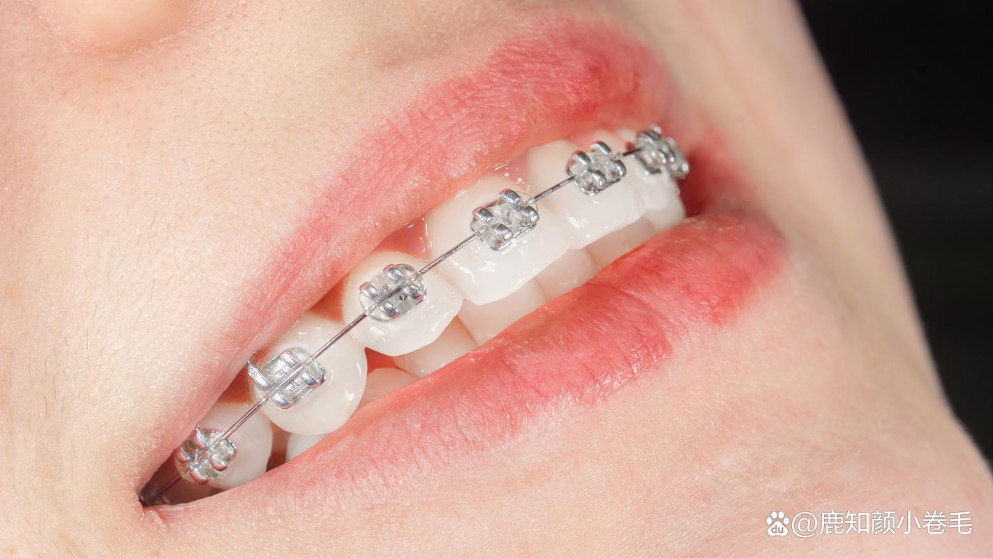 重庆哪里矫正牙齿好-图1