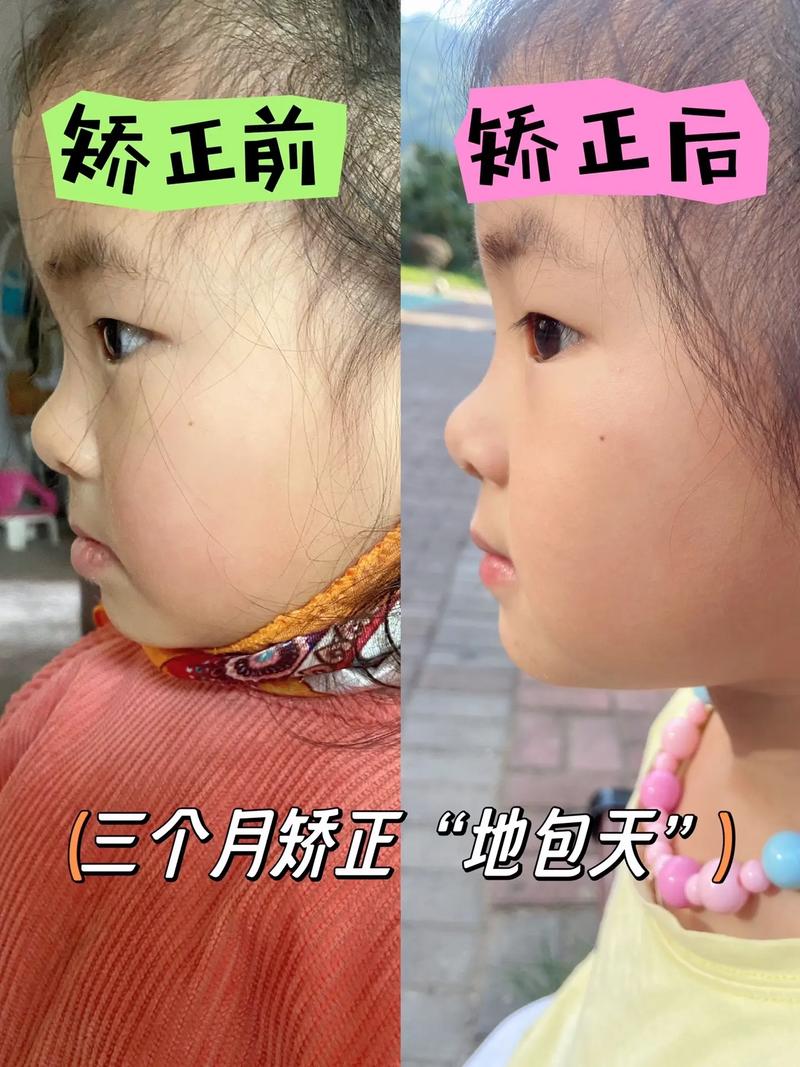 牙齿地包天能矫正吗？-图2