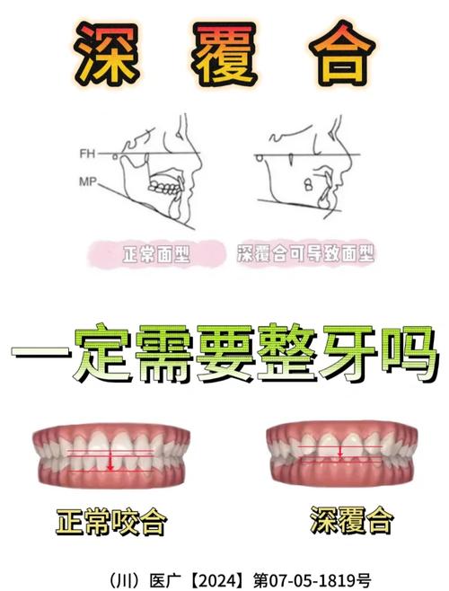 牙齿深覆盖怎么矫正-图1