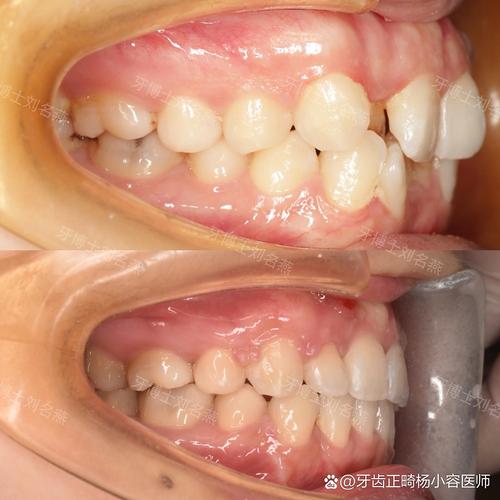 牙齿长期不矫正，会对咀嚼、美观和健康有哪些影响？-图3