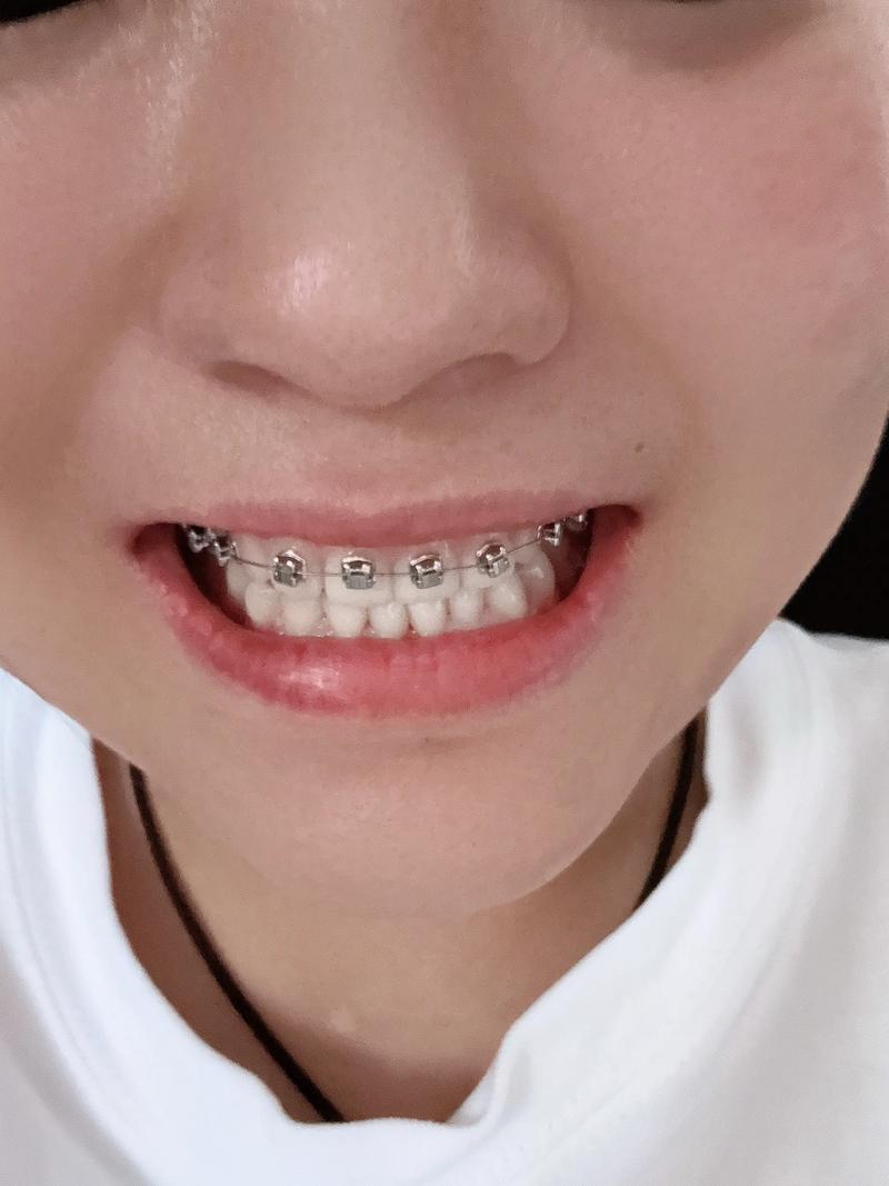 自己矫正牙齿，真的可以吗？-图1
