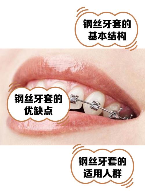 钢丝矫正牙齿的费用大概需要多少呢？求有经验的朋友告知一下！-图2