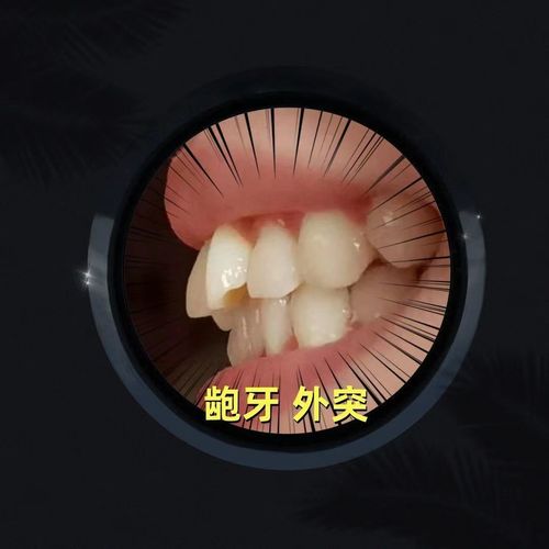 牙齿矫正透明牙套效果如何？舒适吗？-图2