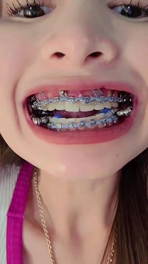 牙齿矫正全过程视频，矫正到底要经历哪些关键步骤？-图2