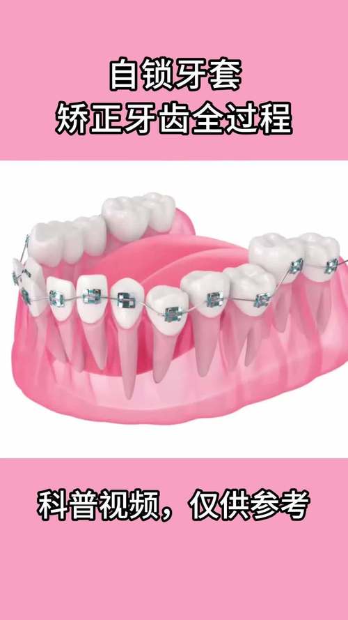 牙齿矫正全过程视频，矫正到底要经历哪些关键步骤？-图3