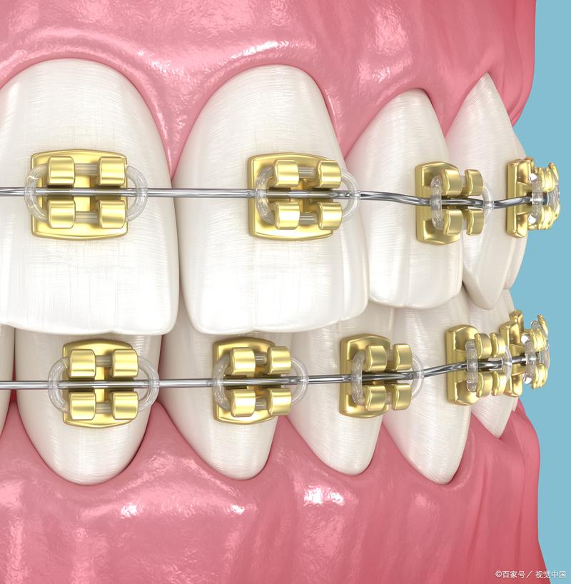 矫正牙齿带环图片-图2 矫正牙齿带环图片-图2