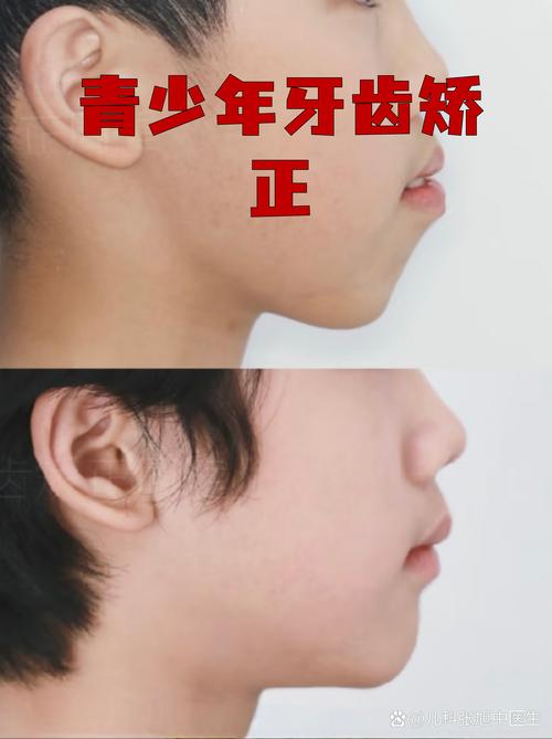 小孩矫正牙齿对生长发育和口腔健康有影响吗？-图2