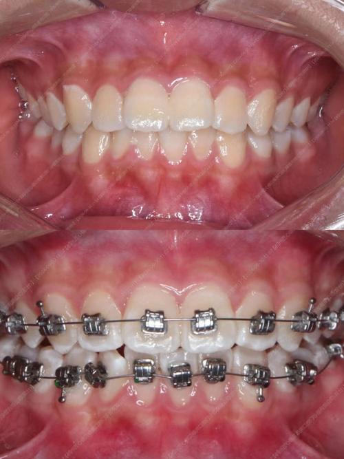 小孩牙齿突出矫正的最佳年龄是几岁合适？-图3