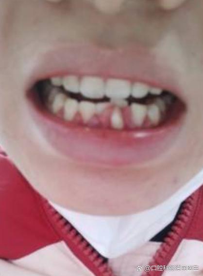 矫正牙齿牙龈长肉，是什么原因导致的？-图1