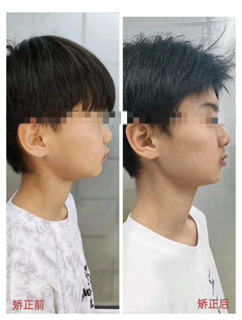 牙齿外突矫正会带来哪些危害?-图2 牙齿外突矫正会带来哪些危害?-图2