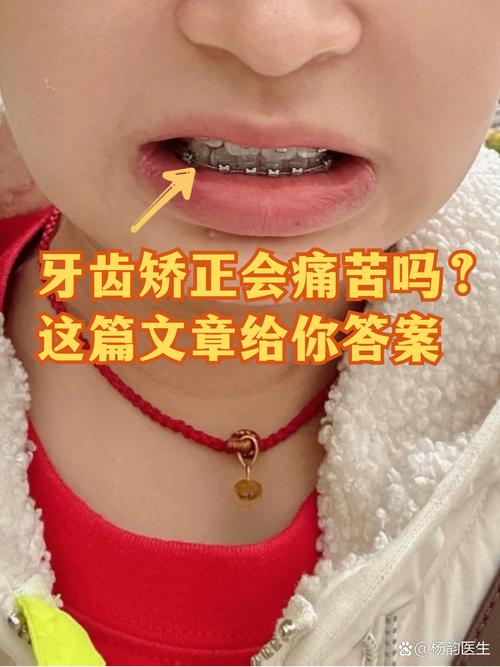 牙齿外突矫正会带来哪些危害?-图3 牙齿外突矫正会带来哪些危害?-图3