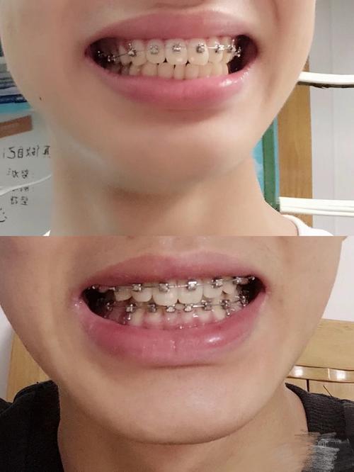 矫正牙齿钢丝脱出，原因是什么？如何正确处理？-图3