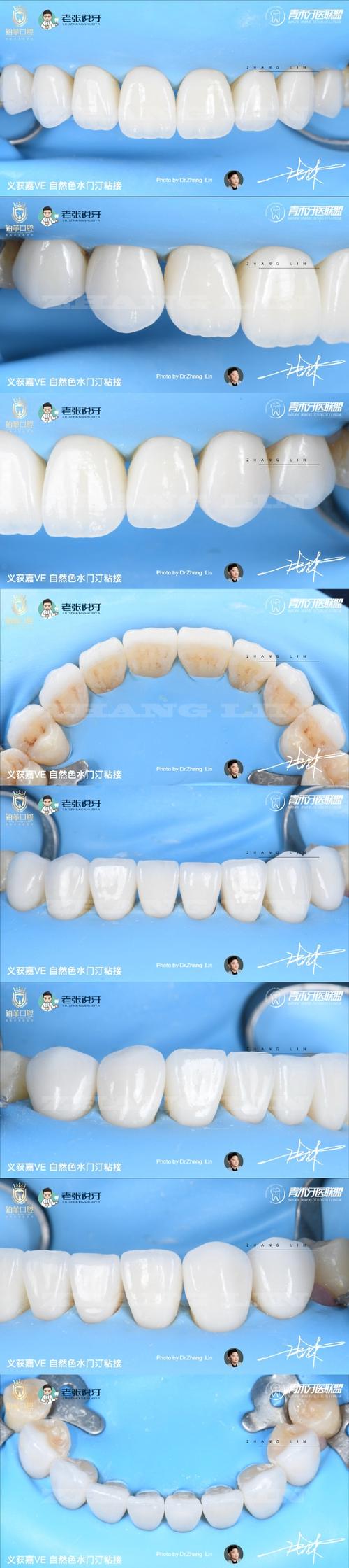 陶瓷冰晶矫正牙齿，美观舒适效果如何？-图2