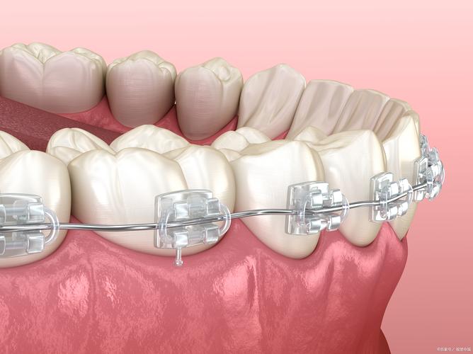 陶瓷冰晶矫正牙齿，美观舒适效果如何？-图3