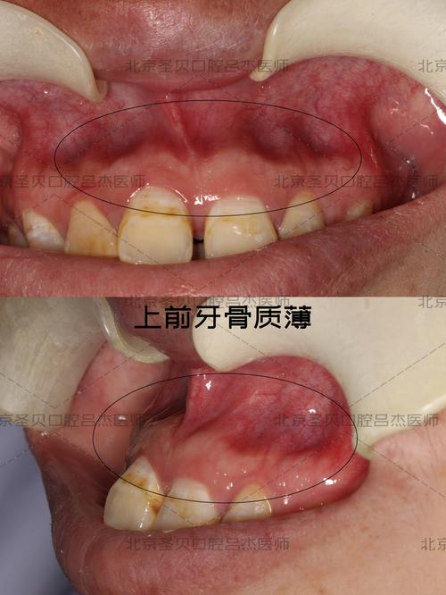 牙齿矫正会影响牙根位置吗?-图2 牙齿矫正会影响牙根位置吗?-图2