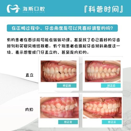 香港矫正牙齿的范围具体包含哪些治疗项目?-图2 香港矫正牙齿的范围具体包含哪些治疗项目?-图2