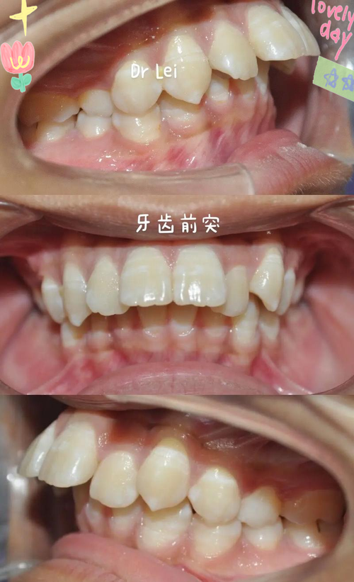 苏州昆山矫正牙齿哪家好？价格效果如何？-图1