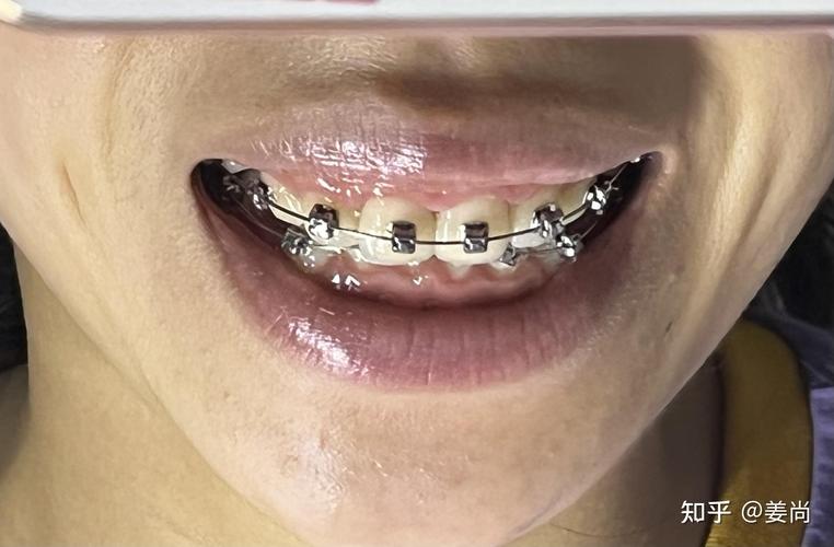 成都牙齿外科矫正效果好不好？有没有风险？术后要注意什么？-图1